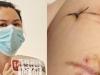 Cô gái bị đâm 22 nhát dao thoát chết nhờ từng nâng cấp vòng 1
