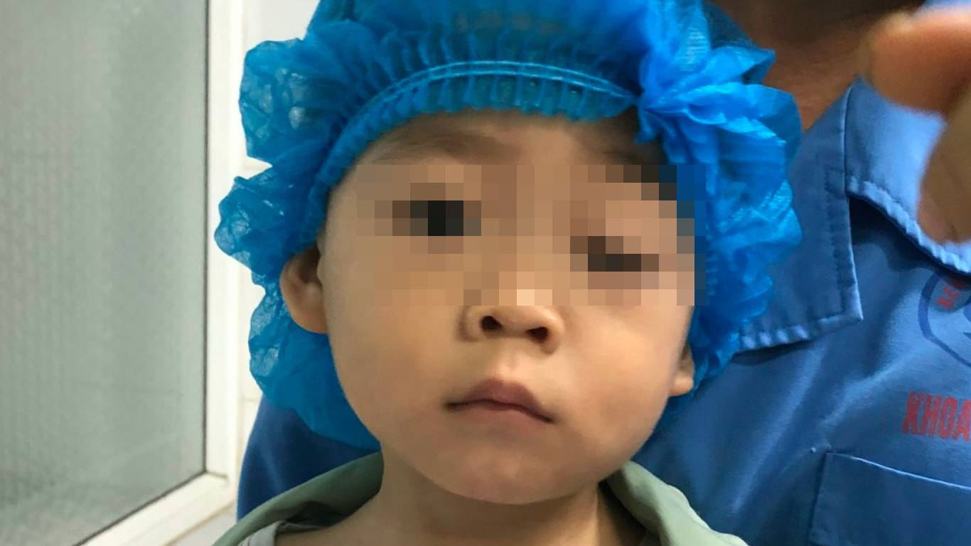 Cháu bé 2 tuổi bị sụp mi bẩm sinh gây nhược thị